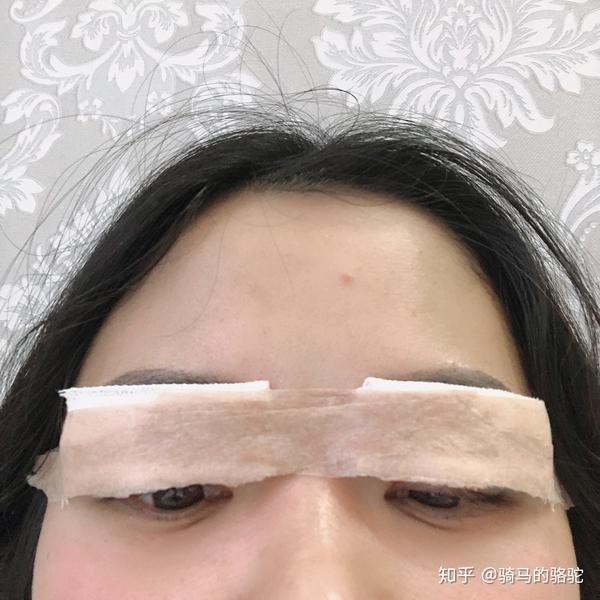 全切双眼皮记录过程