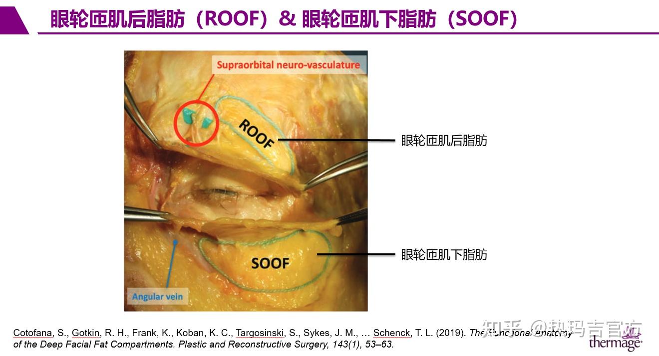 神经的脂肪层,称为眼轮匝肌后脂肪(roof)和眼轮匝肌下脂肪(soof)