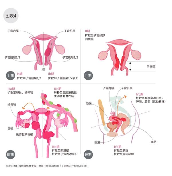 日本专家谈肿瘤子宫癌