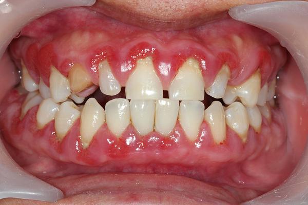 牙齿排列不齐可导致牙龈萎缩.