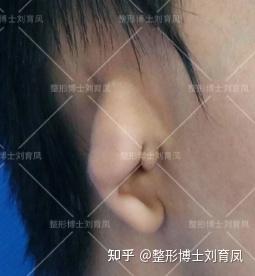 或同时伴有患侧颌面部畸形,是仅次于唇腭裂的第二大颅面部先天性畸形