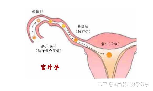 胚胎在进入子宫腔的过程当中游离到子宫腔外部着床并发育的异常妊娠