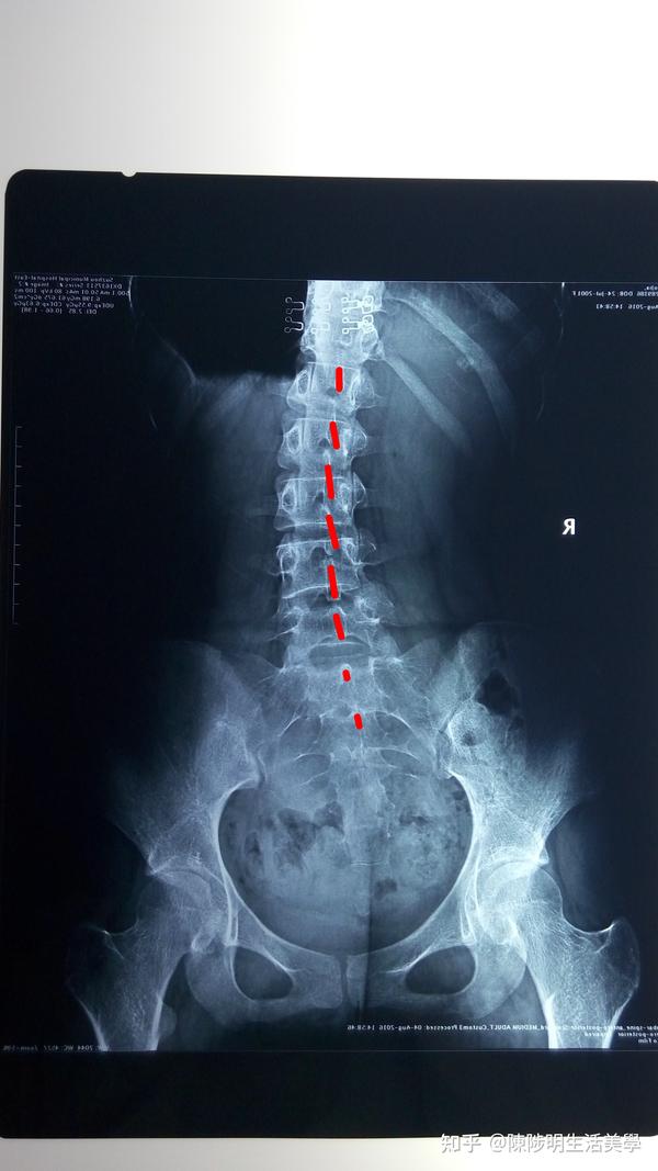 下面这张x光片可以表示脊椎侧弯,从后面看腰椎棘突的连线像写一个「c