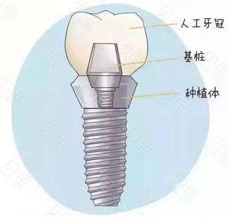 种植牙的组成结构