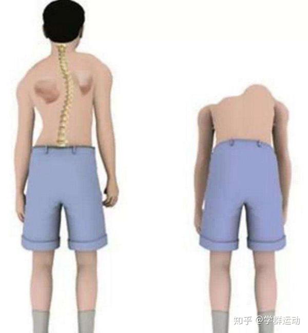 2) 不良姿势造成的肩胛骨位置异常(如脊柱侧弯,圆肩驼背,翼状肩胛骨)