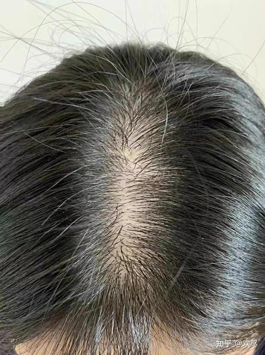 这次脱发终于好了,脂溢性脱发不能拖!