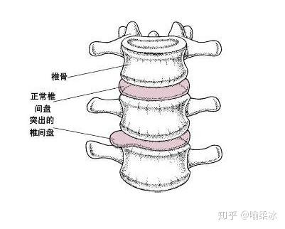 下腹痛或大腿痛 高腰椎间盘突出症时,神根神支配区的小腹,腹股沟