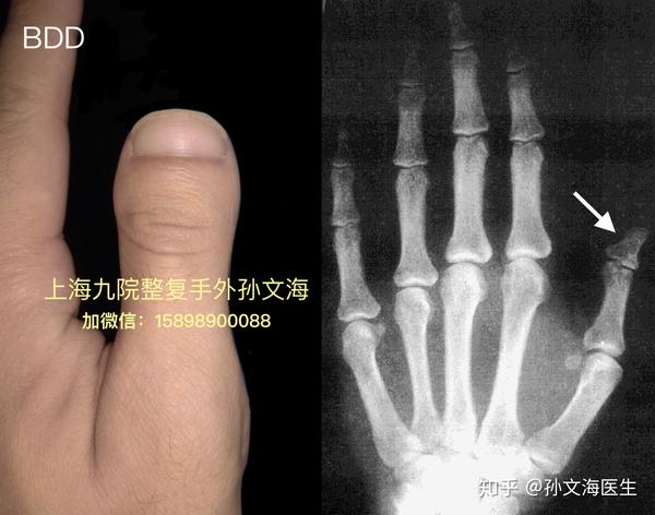 e 掌骨短小,指骨长度正常(e1: 第四跖骨短小症) 图1.