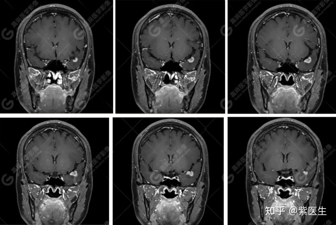 【高尚病例】少见类型脑膜瘤回顾分析