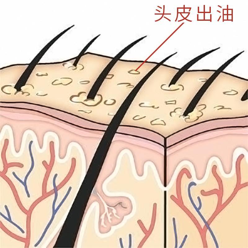 头皮为什么会出油