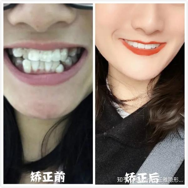牙齿前突的现象在中国人中算是相当常见的,除了牙齿前突引起的嘴巴