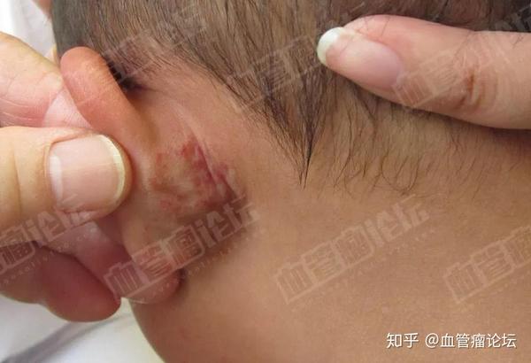 成都四个月耳部毛细血管瘤案例男童耳部毛细血管大如第三只耳朵