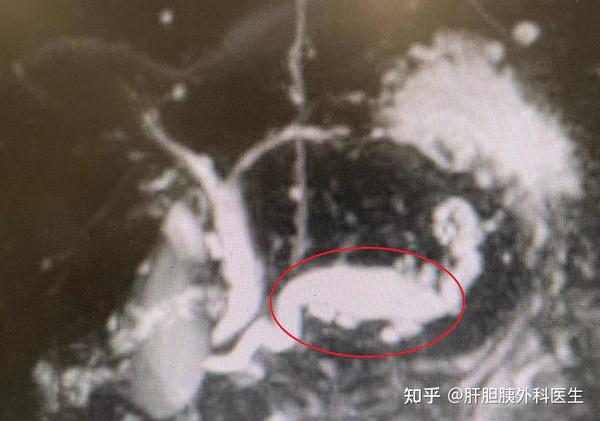 偶然发现的胰管扩张竟是胰腺癌的癌前病变