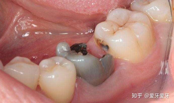 你知道你的牙齿是怎么下岗的吗? 【图健】