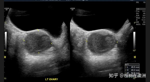 巧克力囊肿子宫内膜异位症病情以及手术进展更新中