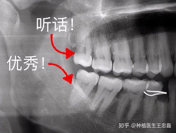 但也不能认为智齿萌出后不痛不痒就不需要拔,因为如果智齿位置长的不