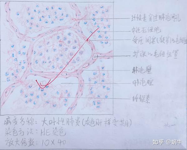 病理红蓝铅笔绘图临床大二