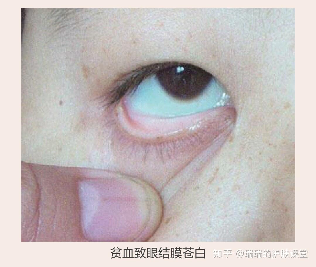 因为这部分毛细血管丰富又在浅表分布,如果贫血,血液颜色变淡,则会更
