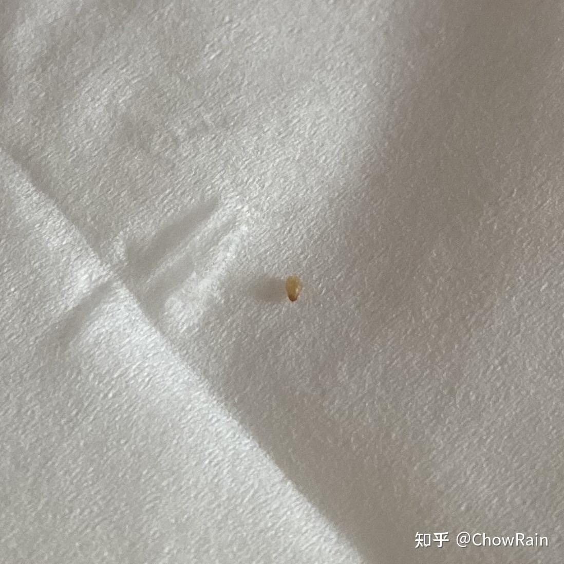 从自己身上扣下来最大的黑头有多大