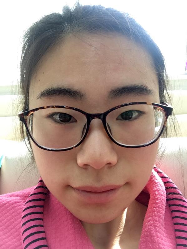 我是2017年4月29号做的全切双眼皮加开眼角,本人严重吊眼梢来一张手术