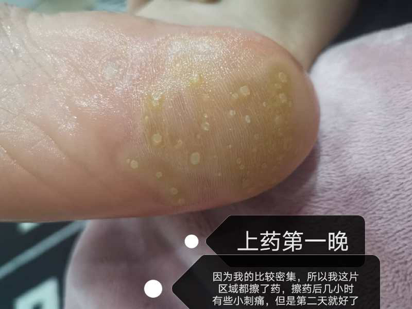 强烈分享跖疣经历,看看这得来不易的脚