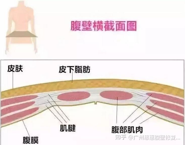 其中与腹壁成形术关系密切的主要是皮肤,浅筋膜和肌肉层,也就是说腹壁