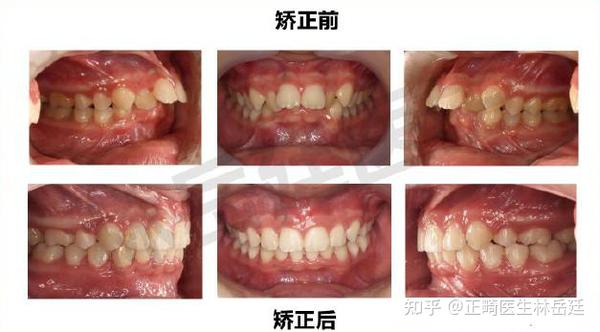 面貌问题 【矫正诊断】 上前牙外翻下前牙稍舌倾,深覆盖覆颌,牙列拥挤