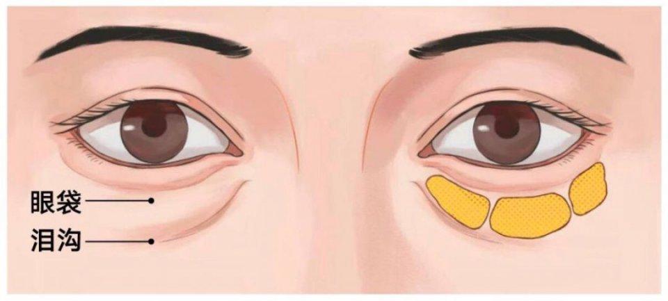 中国眼整形修复专家邢新教授助理 过去,除了少数先天性遗传,眼袋形成