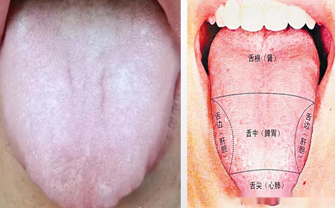 我们所提的舌胖,其实在中医里指的就是"胖大舌,舌体肥大而厚,而这种