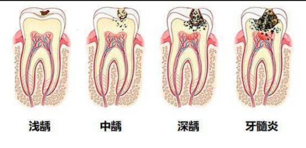 蛀牙从小洞不补到大洞吃苦总共分几步