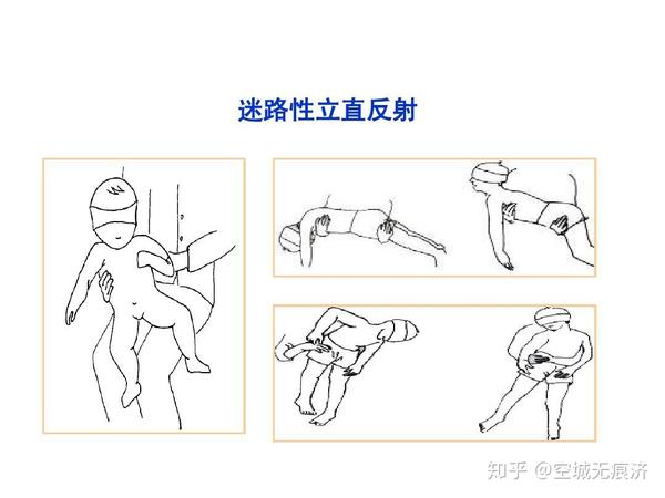 迷路性立直反射: 当头部位置发生变化时,从中耳发出的信号经过前庭