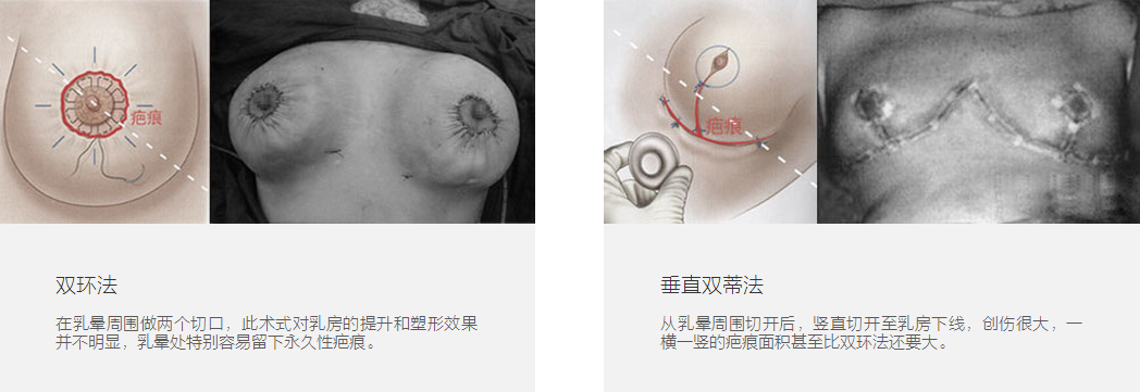 传统矫正方式:必留疤多数女性在哺乳后有乳房下垂情况,国内乳房下垂