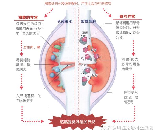 发生肿,痛;随后滑膜细胞会增生,滑膜肥大,形成血管翳,破坏关节结构