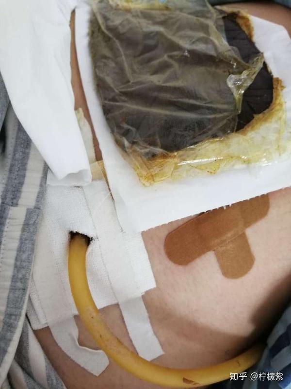 做微创阑尾炎手术是一种什么体验?