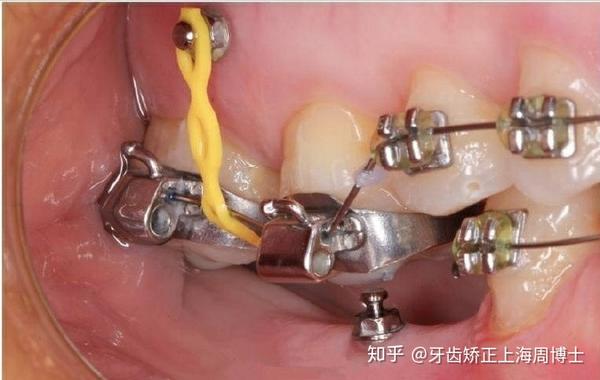 6,矫正异位牙齿:帮助个别不在队列中的牙齿归队.