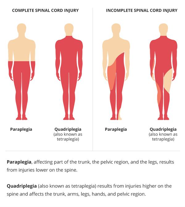 paraplegia and tetraplegia