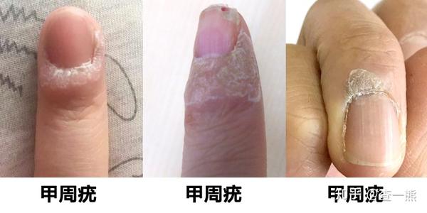 【甲下疣:跖疣长在指甲下方,常导致指甲没发正常生长.