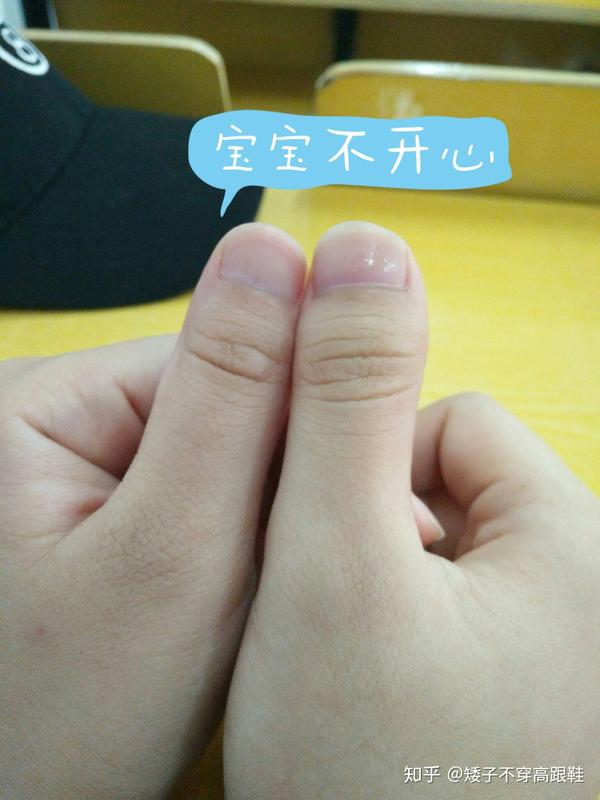 为什么我的大拇指又宽又短?