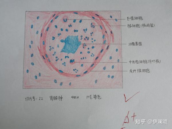 4.嗜酸性粒细胞:胞浆强嗜酸性(颜色与红细胞差不多),八字核 5.