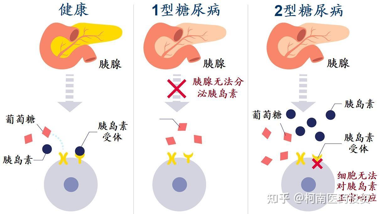 按照致病机理,糖尿病主要分为1型及2型糖尿病.