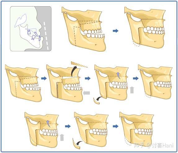 做正颌手术是一种怎样的体验?