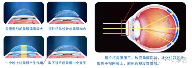 解决这个问题有两种方法,一个是让眼轴变短,另一个是让凸起的眼角膜变