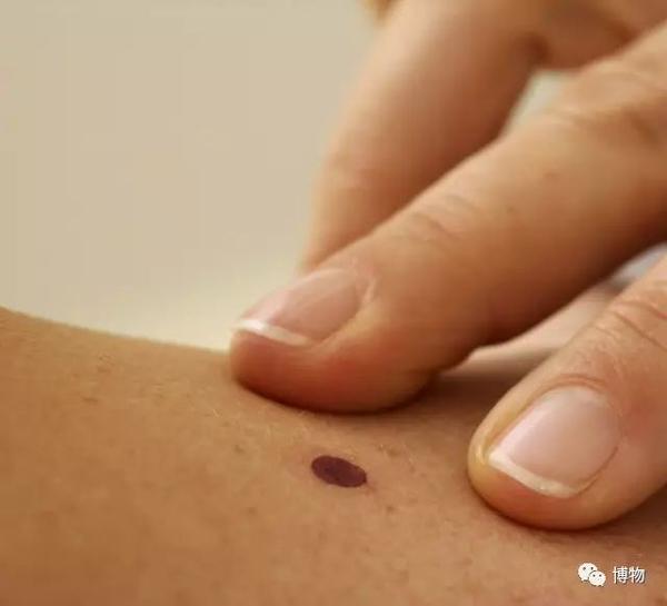 人活一口气 谁还不是个有"痣"人士?