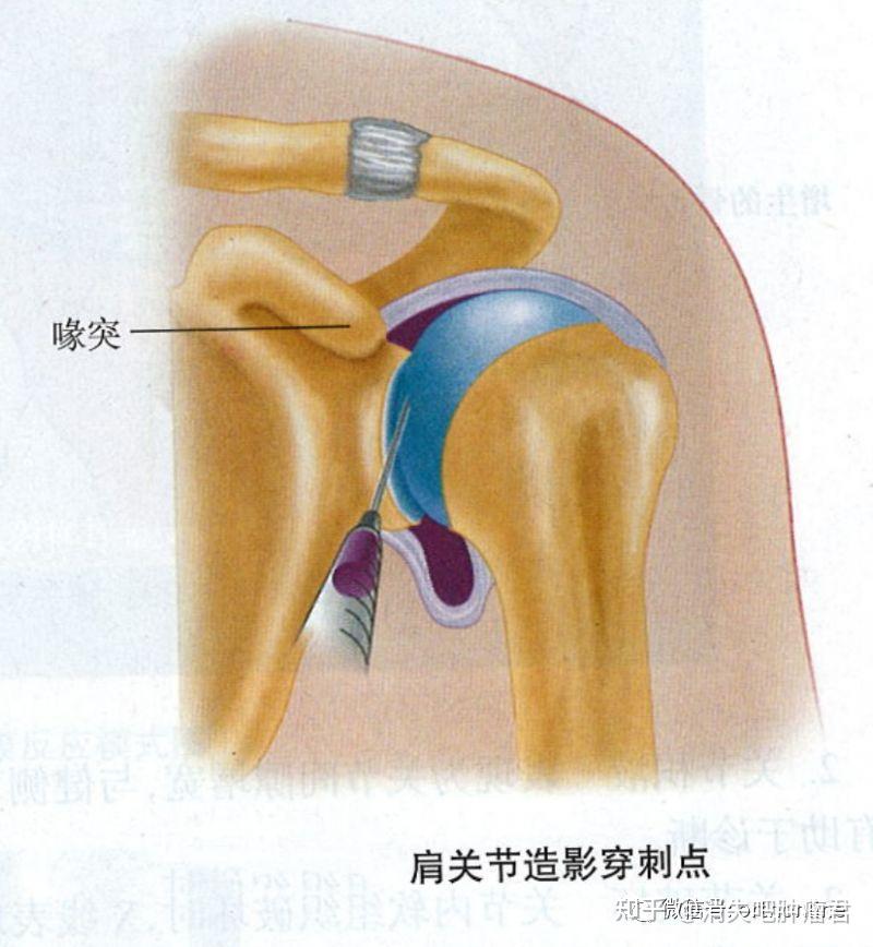 肩关节造影