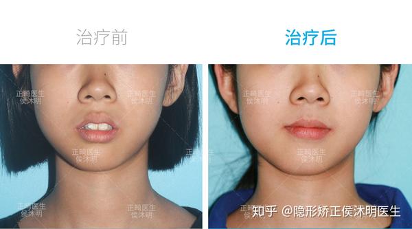 指导患者做唇肌训练. 矫正效果:全口牙列排齐,后牙建立中性咬合关系
