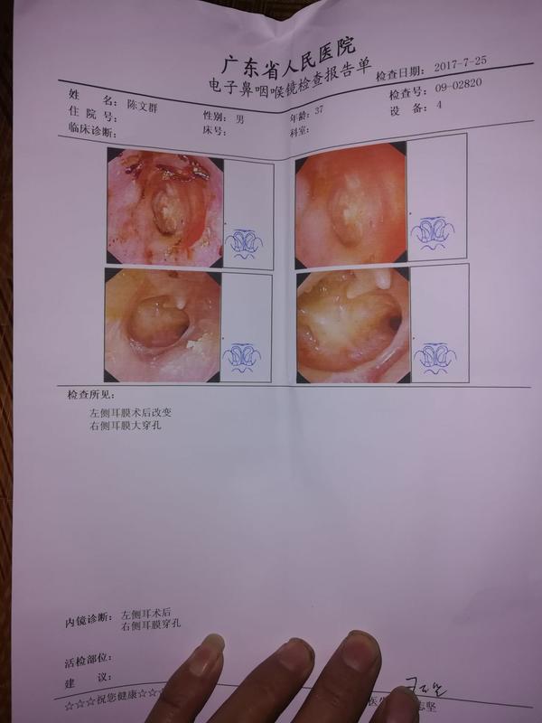 26号出院,耳膜大穿孔医生给我做了个微创手术,术后说是很成功,听小骨