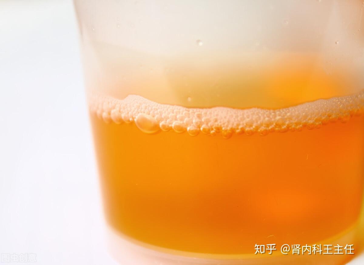 尿液颜色黄是肾不好排除这3个原因最好还是去查查吧