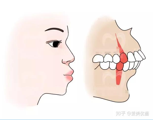 怎样判断嘴凸是骨性的还是牙性的