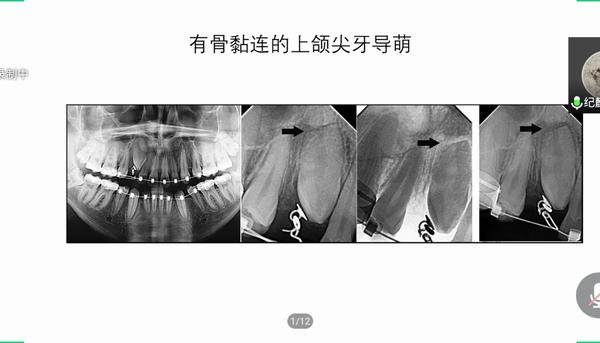 赛德阳光口腔北京蓝色港湾门诊部纪麟彦院长分享骨黏连上颌尖牙导萌