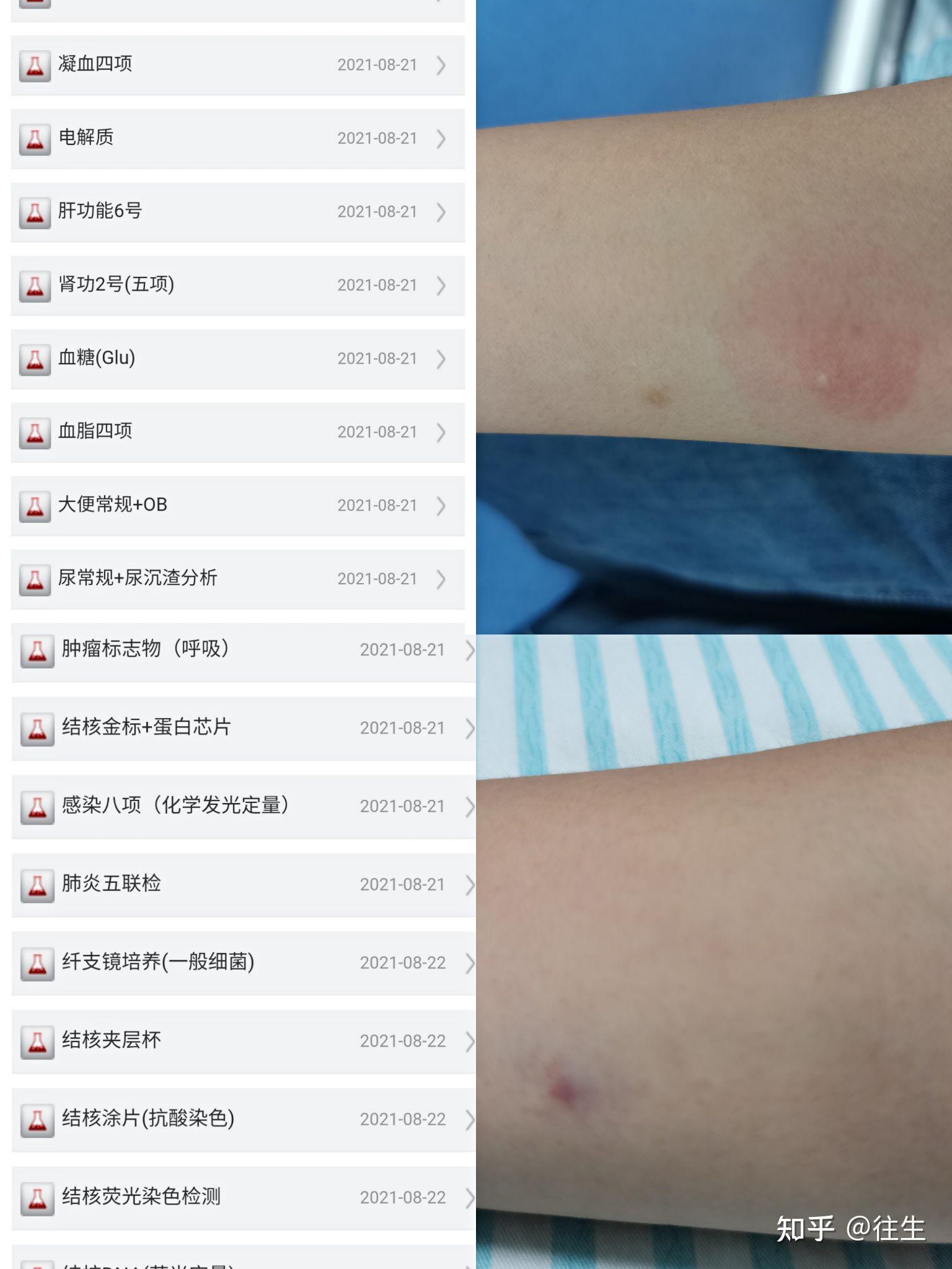 检查结果也是发现气管狭窄和有白色坏死物堵塞,彭氏夹层杯阳性.